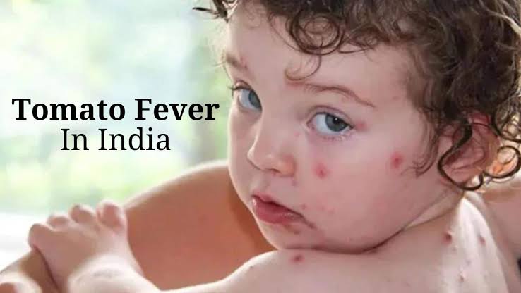 தக்காளி காய்ச்சலை கட்டுப்படுத்த கேரள  எல்லையில் கண்காணிப்பு..