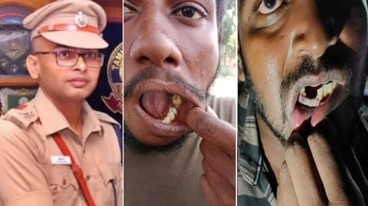 பல் பிடுங்கிய விவகாரம்- 24 போலீசார் பணியிட மாற்றம்..