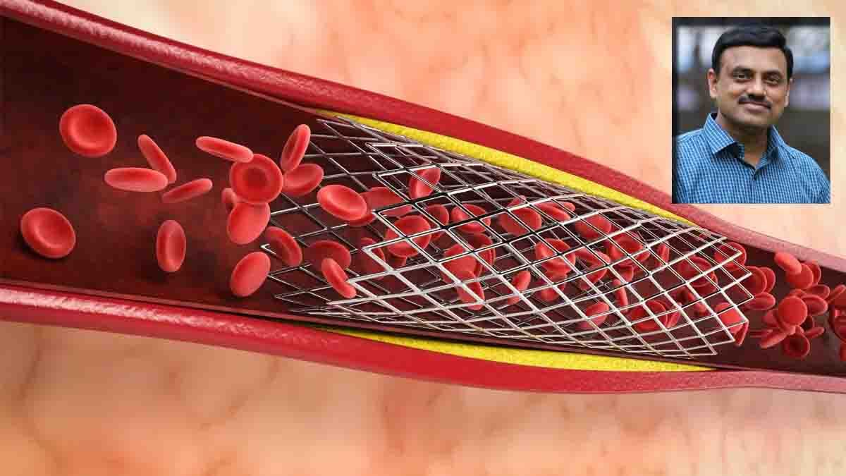 coronary angiography test stunt - 2026